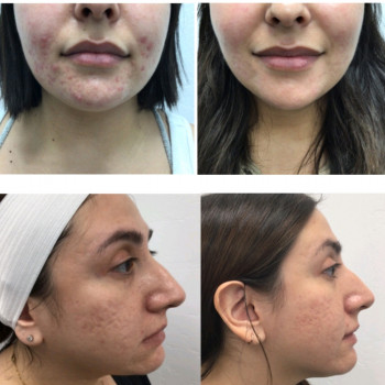 Мікроголковий РФ ліфтинг нижньої половини обличчя
                    Косметологический центр  Ужгород