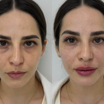 Мікроголковий РФ ліфтинг повік (верхні або нижні)
                    Косметологический центр  Ужгород