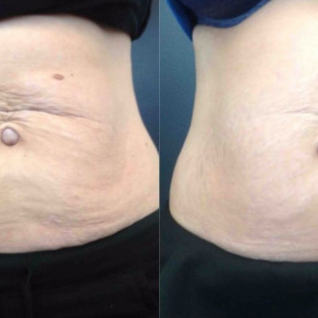 Полікапролактон (PLC) колагеностимулятор
                    Косметологический центр  Ужгород