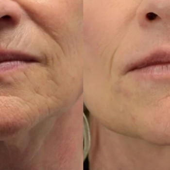 Полікапролактон (PLC) колагеностимулятор
                    Косметологический центр  Ужгород