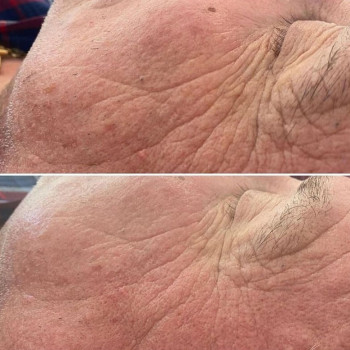 Полікапролактон (PLC) колагеностимулятор
                    Косметологический центр  Ужгород