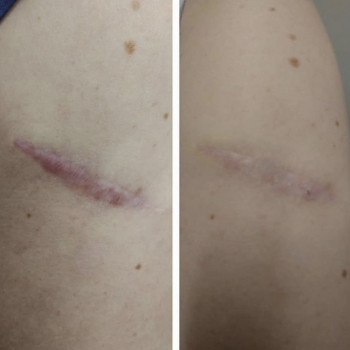 Полікапролактон (PLC) колагеностимулятор
                    Косметологический центр  Ужгород