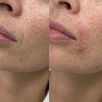 Полікапролактон (PLC) колагеностимулятор
                    Косметологический центр  Ужгород