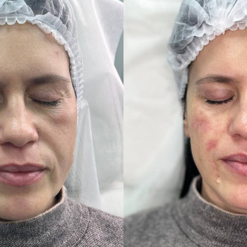 Полікапролактон (PLC) колагеностимулятор
                    Косметологический центр  Ужгород