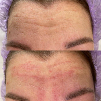 Полікапролактон (PLC) колагеностимулятор
                    Косметологический центр  Ужгород