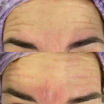 Полікапролактон (PLC) колагеностимулятор
                    Косметологический центр  Ужгород