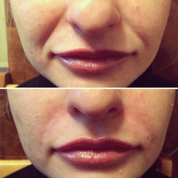 Полікапролактон (PLC) колагеностимулятор
                    Косметологический центр  Ужгород