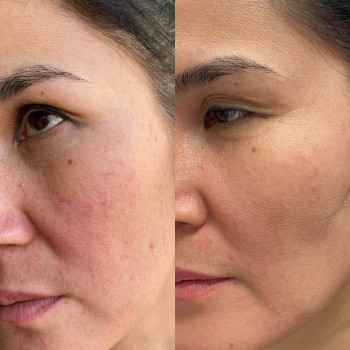 Полікапролактон (PLC) колагеностимулятор
                    Косметологический центр  Ужгород