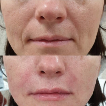 Полікапролактон (PLC) колагеностимулятор
                    Косметологический центр  Ужгород