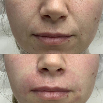 Полікапролактон (PLC) колагеностимулятор
                    Косметологический центр  Ужгород