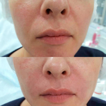 Полікапролактон (PLC) колагеностимулятор
                    Косметологический центр  Ужгород