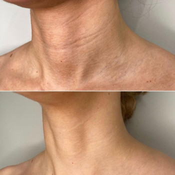 Полікапролактон (PLC) колагеностимулятор
                    Косметологический центр  Ужгород