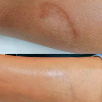 Полікапролактон (PLC) колагеностимулятор
                    Косметологический центр  Ужгород