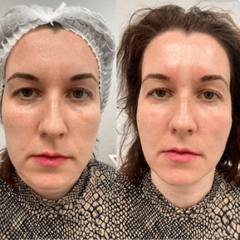 Полікапролактон (PLC) колагеностимулятор
                    Косметологический центр  Ужгород