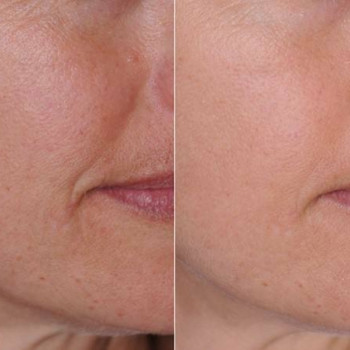 Полікапролактон (PLC) колагеностимулятор
                    Косметологический центр  Ужгород