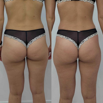 Triada PBSerum  ліполітики
                    Косметологический центр  Ужгород