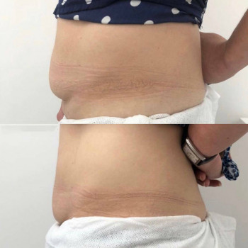 Triada PBSerum  ліполітики
                    Косметологический центр  Ужгород