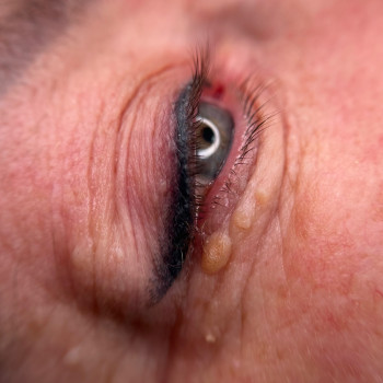 Зажившие стрелки 
Перманент стрелок
 