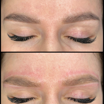 Лазерное удаление старого перманента 
 