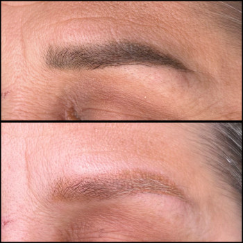 Лазерное удаление старого татуажа 
 