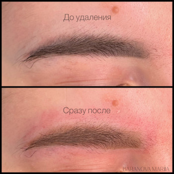 Лазерное удаление старого перманента 
 