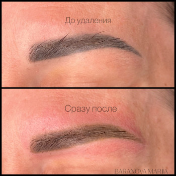 Лазерное удаление старого татуажа 
 