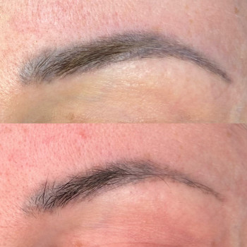 Лазерное удаление старого микроблейдинга 
 