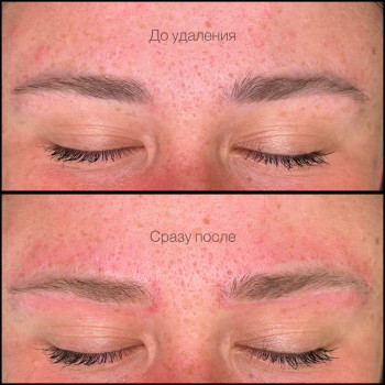 Лазерное удаление старого перманента 
 