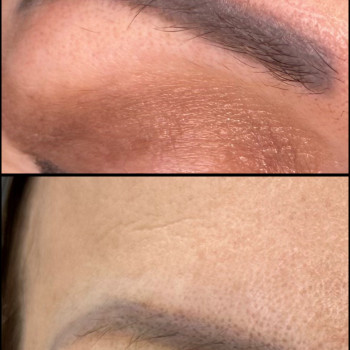 Лазерное удаление старого перманента 
Промежуточный результат 
 