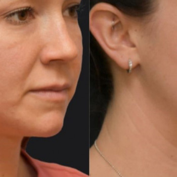 Гідролізований колаген ін'єкції
                    Косметологический центр  Ужгород