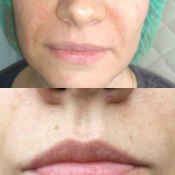 Гідролізований колаген ін'єкції
                    Косметологический центр  Ужгород