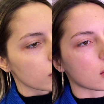 Безін'єкційна мезотерапія
                    Косметологический центр  Ужгород