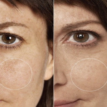 Безін'єкційна мезотерапія
                    Косметологический центр  Ужгород