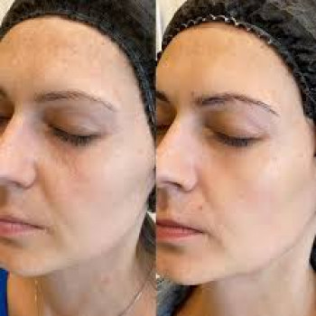 Безін'єкційна мезотерапія
                    Косметологический центр  Ужгород