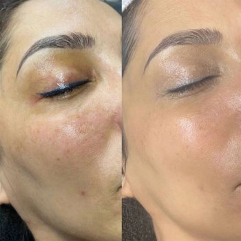 Пілінг PRX-T33
                    Косметологический центр  Ужгород