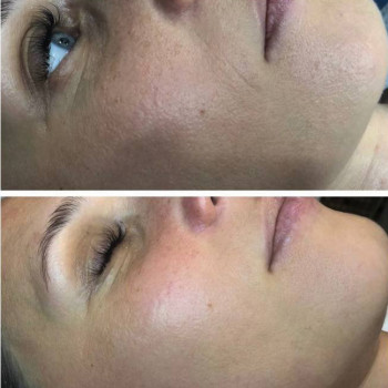 Пілінг PRX-T33
                    Косметологический центр  Ужгород