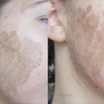 Пілінг PRX-T33
                    Косметологический центр  Ужгород