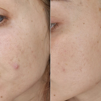 Мигдальний пілінг
                    Косметологічний центр  Ужгород