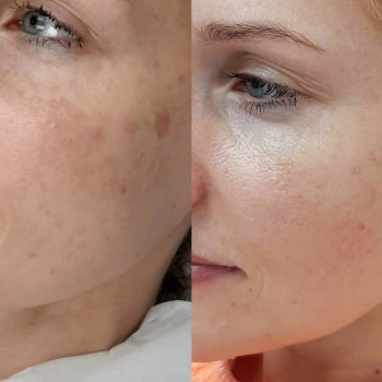 Мигдальний пілінг
                    Косметологічний центр  Ужгород