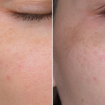 Лакто пілінг (молочний)
                    Косметологічний центр  Ужгород