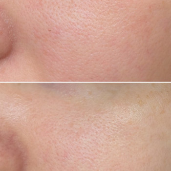 Лакто пілінг (молочний)
                    Косметологічний центр  Ужгород