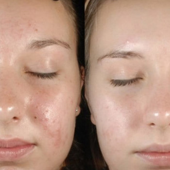 Лакто пілінг (молочний)
                    Косметологічний центр  Ужгород