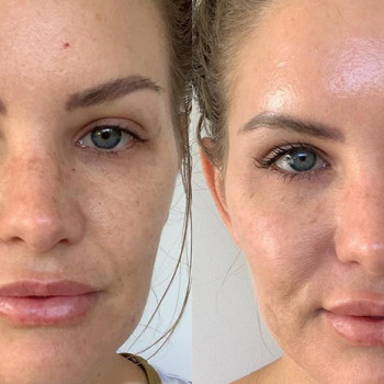 Лакто пілінг (молочний)
                    Косметологічний центр  Ужгород