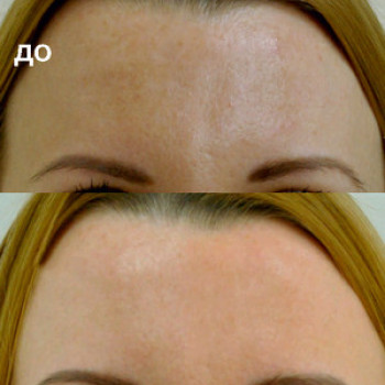 Лакто пілінг (молочний)
                    Косметологічний центр  Ужгород