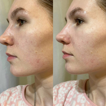 Лакто пілінг (молочний)
                    Косметологічний центр  Ужгород