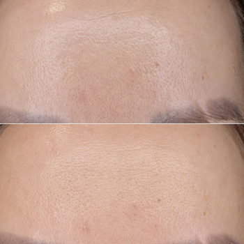 Лакто пілінг (молочний)
                    Косметологічний центр  Ужгород