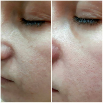 Азелаїновий пілінг
                    Косметологический центр  Ужгород