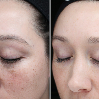 Азелаїновий пілінг
                    Косметологический центр  Ужгород