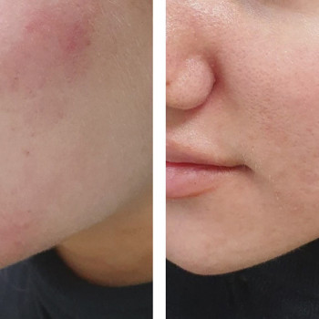 Азелаїновий пілінг
                    Косметологический центр  Ужгород