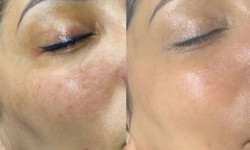 Петрушковий пілінг Косметологический центр  Ужгород